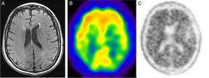 Corte axial de resonancia magnética en T2 y secuencia FLAIR (A), corte axial de tomografía por emisión de fotón único con 99mTc-HMPAO (B) y corte axial de tomografía por emisión de positrones con 18F-florbetapir (C). Varón de 74 años de edad con deterioro cognitivo y sospecha de enfermedad de Alzheimer. En la imagen A se observa una pérdida generalizada de masa encefálica sin predominio lobar y signos de leucopatía periventricular laminar gruesa. En el estudio B se identifica hipoperfusión en la región parietooccipital paramedial bilateral, más intensa en el lado izquierdo. En C se aprecia una pérdida de contraste entre la sustancia gris-blanca, compatible con enfermedad de Alzheimer.