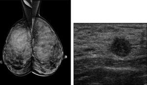 Patrón mamario glandular extremadamente denso. Mamografía: normal. Ecografía: Nódulo espiculado en mama izquierda. Carcinoma ductal infiltrante.