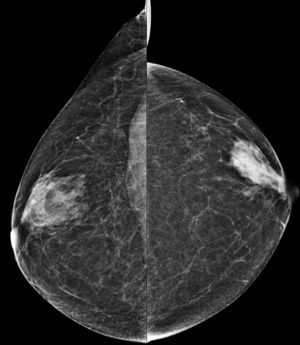 Proyección craneocaudal de ambas mamas. Patrón heterogéneamente denso (categoríaC) según la 5.a edición del BI-RADS. Porcentaje de tejido denso menor del 25% del total de la mama.