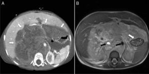 Rabdomiosarcoma alveolar retroperitoneal. A) Corte transversal de TC abdominal con contraste intravenoso que muestra una extensa tumoración retroperitoneal (flechas), de densidad heterogénea, que desplaza y comprime las vísceras abdominales. B) Corte transversal de RM potenciada en T2: la tumoración es hiperintensa, con un área de degeneración necrótico-quística (asterisco) en su interior, que engloba a los vasos retroperitoneales (flechas negras) y el estómago (flecha blanca).