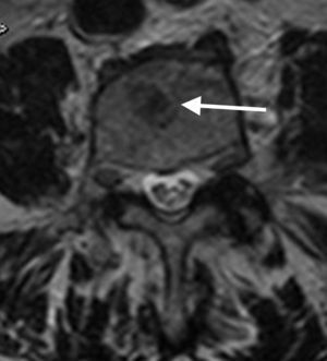 T2 axial del raquis lumbar que muestra lesión nodular con halo periférico más hiperintenso en el cuerpo vertebral (flecha) indicativo de metástasis.