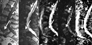 Edema benigno y maligno en el mapa ADC. RM lumbar en paciente con metástasis ósea conocida por cáncer de mama, que presenta en la actualidad lumbalgia aguda. a) Imagen sagital en FSE T1 que muestra múltiples lesiones focales, especialmente en L1 y edema difuso en L5 (flechas). b) El sagital STIR correspondiente muestra un edema más difuso en ambos niveles, difícil de diferenciar si es infiltrante o no infiltrante. c) Imagen sagital en difusión en b=0 mm2/s y d) en b=800 mm2/s que muestra la persistencia de hiperseñal de la lesión a nivel de L1 (flecha corta) y menor señal en L5 (flecha larga). e) El corte sagital en el mapa ADC confirma la hiposeñal en L1 (flecha corta) con valor ADC de 0,7×10-3 mm2/s e hiperseñal en L5 con un valor de ADC de 1,6×10-3 mm2/s. La lesión en L1 es debido a una metástasis y en L5 debido a una fractura de insuficiencia, donde en la imagen en sagital FSE T1 (a) se visualiza línea horizontal subcortical (flecha), lo que justifica los síntomas actuales.