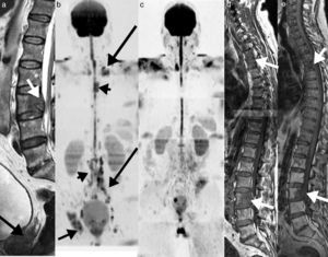 Varón de 61 con lumbalgia aguda. a) Detección de metástasis lumbar en imagen sagital FSE T1 (flecha blanca) de tumor primario desconocido. b) El estudio de detección del tumor primario y estadificación en imagen coronal de reconstrucción multiplanar con inversión del contraste en escala de grises de difusión de cuerpo entero muestra la detección primaria de neoplasia de próstata (flecha gruesa en a), metástasis óseas del raquis (cabezas de flecha), pelvis derecha (flecha corta) y múltiples adenopatías a nivel retroperitoneal y torácico (flechas largas). c) El control en imagen RM coronal de reconstrucción multiplanar con inversión del contraste en escala de grises en difusión de cuerpo entero a los 4 meses posterior al tratamiento con bloqueo hormonal y radioterapia demuestra ausencia de lesiones, en relación con respuesta completa. d) Imagen sagital FSE T1 en el estudio inicial, mostrando la afectación de D4 y L3 (flechas). e) Imagen sagital en FSE T1 a los 4 meses postratamiento en radioterapia y bloqueo hormonal que muestra morfológicamente estabilidad (flechas), mientras la difusión (c) permite valorar la respuesta completa por ausencia de restricción de la difusión (resolución de las lesiones en b; cabezas de flecha), en correlación con la respuesta clínica de descenso del PSA. El criterio únicamente morfológico hubiera interpretado de forma incorrecta la respuesta terapéutica.