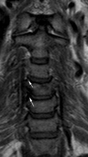 Plano coronal FSET1 donde se identifica la artrosis incipiente en las articulaciones unciformes (flecha).