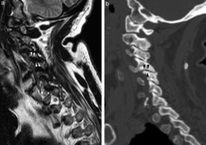 Artrosis facetaria, correlación de RM con imagen FSE potenciada en T2 plano parasagital (a) y tomografía computarizada multidetector en plano sagital (b) demostrando artrosis facetaria (cabezas de flechas).