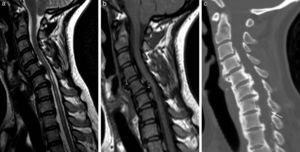 Hiperostosis idiopática difusa (DISH). Imagen potenciada en T2 (a) y potenciada en T1 (b) en plano sagital donde se visualiza calcificación del LLA(1), LLP (2) y ligamento interespinoso (flecha), así como una importante mielopatía., y tomografía computarizada multidetector de reconstrucción sagital (c).
