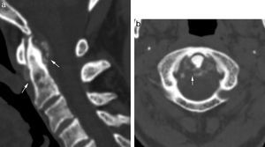 Artropatía por depósito de CPPD. Tomografía computarizada multidetector en plano sagital donde se muestran las importantes calcificaciones periodontoideas (flechas). Online correspondiente imagen en plano axial (b).