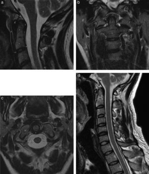 Resonancia magnética de columna cervical. Imágenes potenciadas en FSE T2 en plano sagital (a), en plano coronal (b) y plano axial (c, online). 1) Proceso odontoides. 2) Ligamento transverso y cruzado. 3) Clivus. 4) Arco anterior de atlas. 5) Arco posterior de atlas. 6) Amígdala cerebelosa. 7) Cuerpo de axis. 8) Ligamento longitudinal posterior (LLP). 9) Membrana tectorial 10) Masas laterales de atlas. 11) Ligamento apical de la apófisis odontoides 12. Ligamento longitudinal anterior (LLA). d) Imagen potenciada en FSE T2 de la columna cervical completa (online); se visualiza la continuidad de los ligamentos LLA (1). LLP (2).