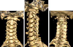 Anatomía de la columna cervical en tomografía computarizada multidetector con con reconstrucciones volumétricas. a) Vista coronal anterior donde se visualizan las articulaciones uncovertebrales y el incremento progresivo del tamaño de los cuerpos vertebrales. b) Vista oblicua (online), que permite la identificación de los agujeros de conjunción. c) Vista posterior (online) las apófisis espinosas, que son bífidas de C2 a C6 (flecha blanca) y mayor en C7, así como las láminas (puntas de flechas negras).