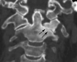 Tomografía computarizada multidetector con reconstrucción MPR en plano coronal, osteoartrosis cervical alta con cambios degenerativos en la articulación atlanto-axoidea izquierda (flechas), y yuxtaposición de hueso alrededor del tip de la odontoides.