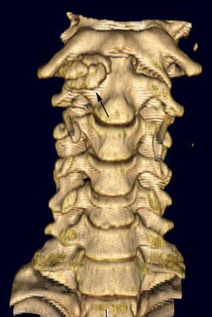 Tomografía computarizada multidetector. Reconstrucción volumétrica que muestra los grandes osteofitos C1-C2 derechos (flecha negra) mientras que el resto de las articulaciones son normales.