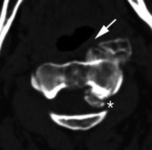 Tomografía computarizada multidetector axial que muestra osteofito C1-C2 anterior que condiciona la compresión esofágica (flecha blanca) y el osteofito posterior (*), compresión medular.