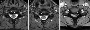 Planos axiales en secuencia FFE T2 a nivel discal en diferentes pacientes. a) Abombamiento difuso (cabezas de flecha). b) Protrusión focal centrolateral derecha (flecha). c) Hernia centrolateral izquierda voluminosa (flecha).