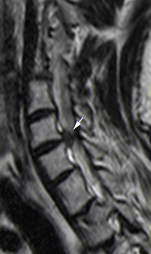 FSE T2 parasagital que muestra una voluminosa hernia extruida (flecha).