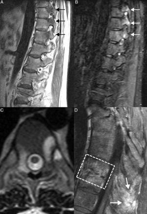 Lesiones inflamatorias activas. A y B) Cortes sagitales de RM en T1 y STIR que demuestran cambios de edema óseo en las apófisis articulares que corresponden a artritis de las articulaciones interapofisarias (flechas). En las esquinas anteriores vertebrales se detectan áreas de depósito de médula ósea grasa y algunos sindesmofitos. C) Corte axial de RM en T2 en el que se observan signos de artritis costovertebral bilateral, con cambios de edema óseo en las carillas articulares. D) Corte sagital de RM en secuencia T1 con supresión grasa tras administrar contraste intravenoso. Se observan signos de entesitis de los ligamentos interespinosos, en forma de captación de contraste (flechas), así como una lesión de Andersson (línea discontinua).