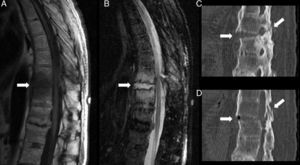 Cortes sagitales de RM en secuencias T1 (A) y STIR (B), y reformateos sagitales de TC (C y D), en los que se detecta una fractura transdiscal (flechas en A y B) asociada a extensos cambios de edema óseo en los cuerpos vertebrales contiguos. La fractura afecta el arco posterior, como se demuestra mejor en C y D (flechas), con moderada afectación del canal raquídeo.