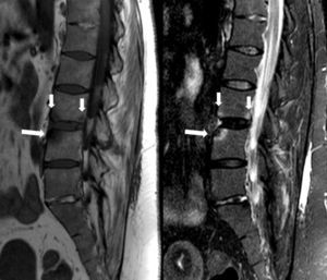 Cortes sagitales de RM en secuencias T1 y STIR. Se observa una lesión de espondilitis en la esquina anterosuperior de L4 (flecha larga), con erosión y cambios de esclerosis subcortical, de baja señal en ambas secuencias, rodeados por cambios de edema óseo. En L3 se detectan otras lesiones de espondilitis anterior y posterior (flechas cortas) constituidas únicamente por cambios de edema óseo. Se identifica anquilosis, con osificación parcial del disco L5-S1, y cuadratura de los cuerpos vertebrales lumbares.