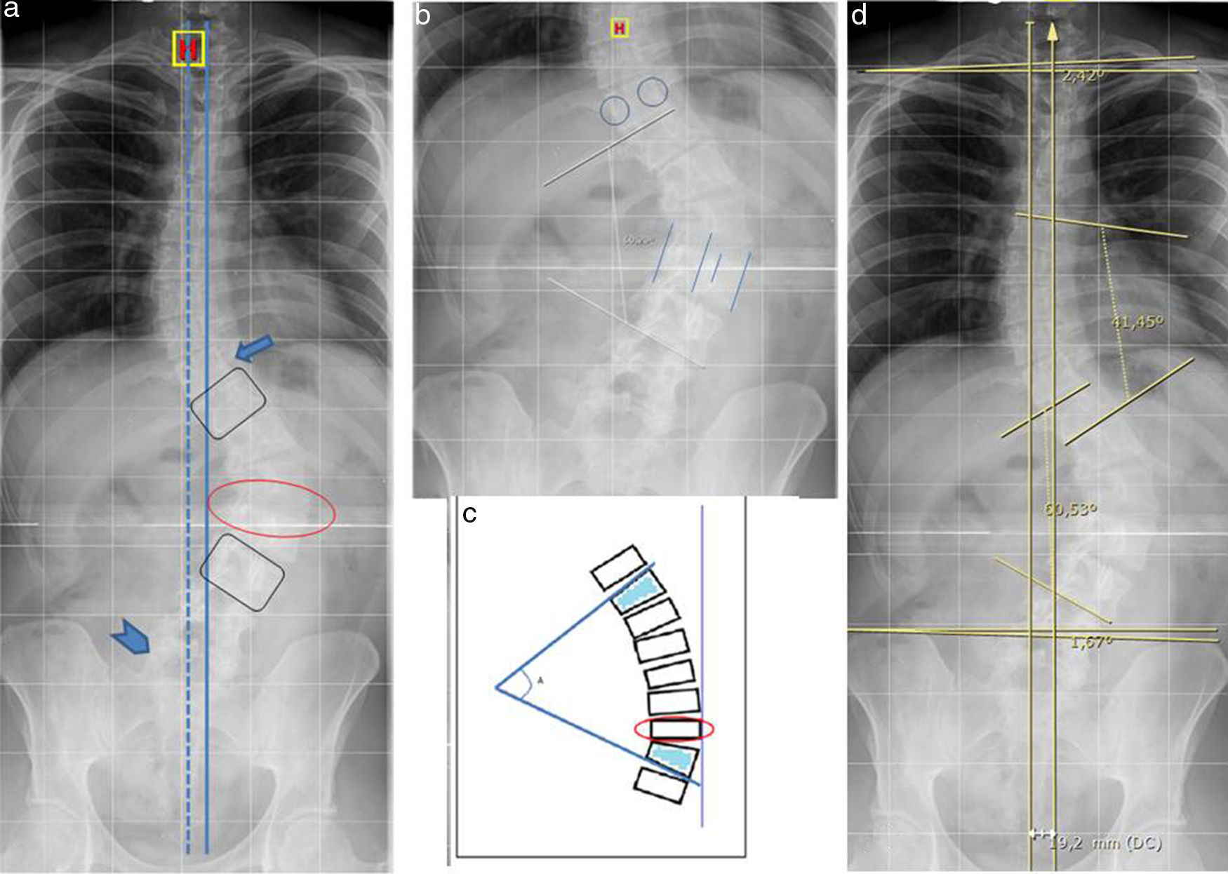 Alteraciones de la alineación vertebral | Radiología