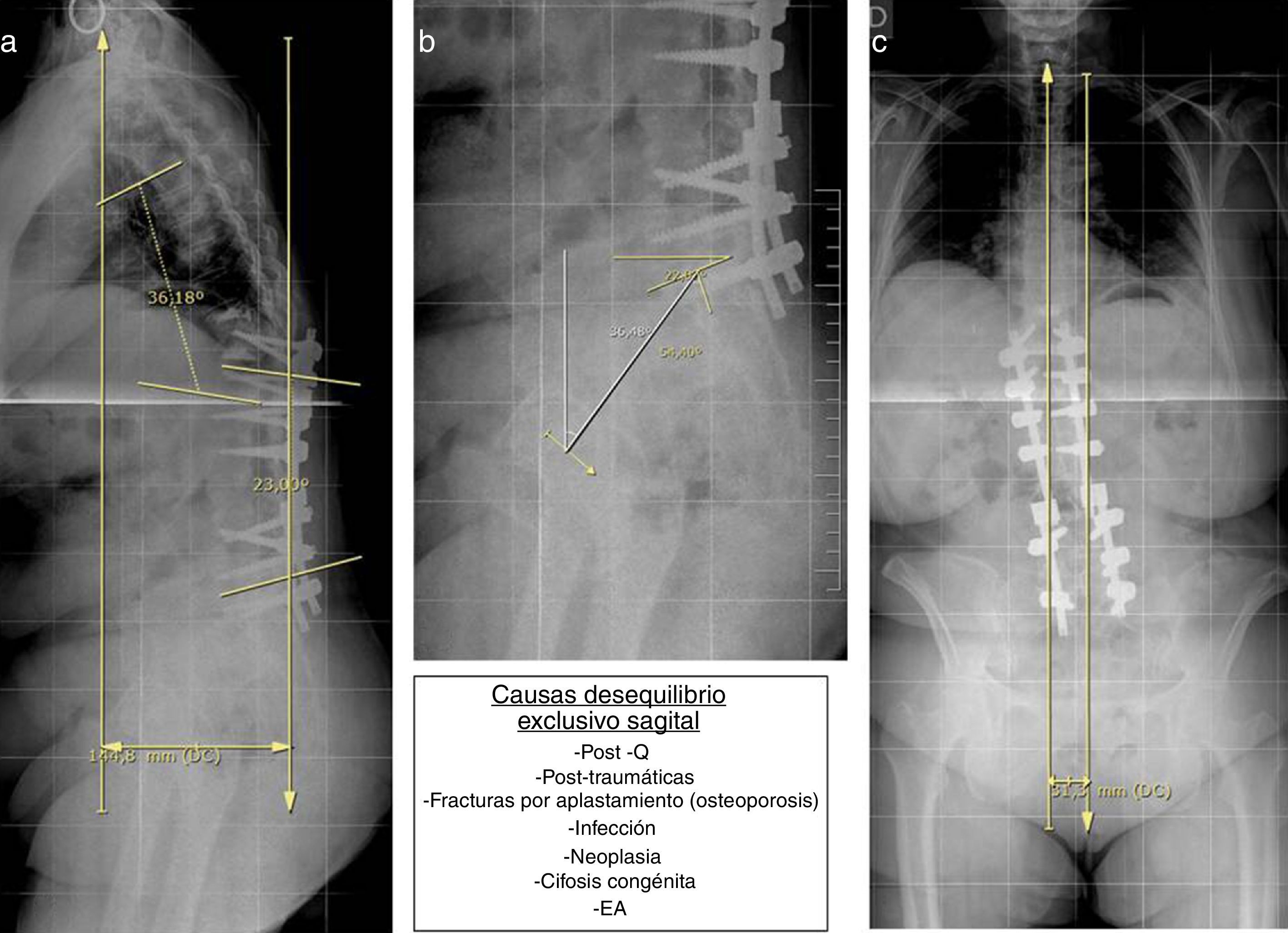 Balance Coronal Radiologia Alteraciones de la alineación vertebral | Radiología