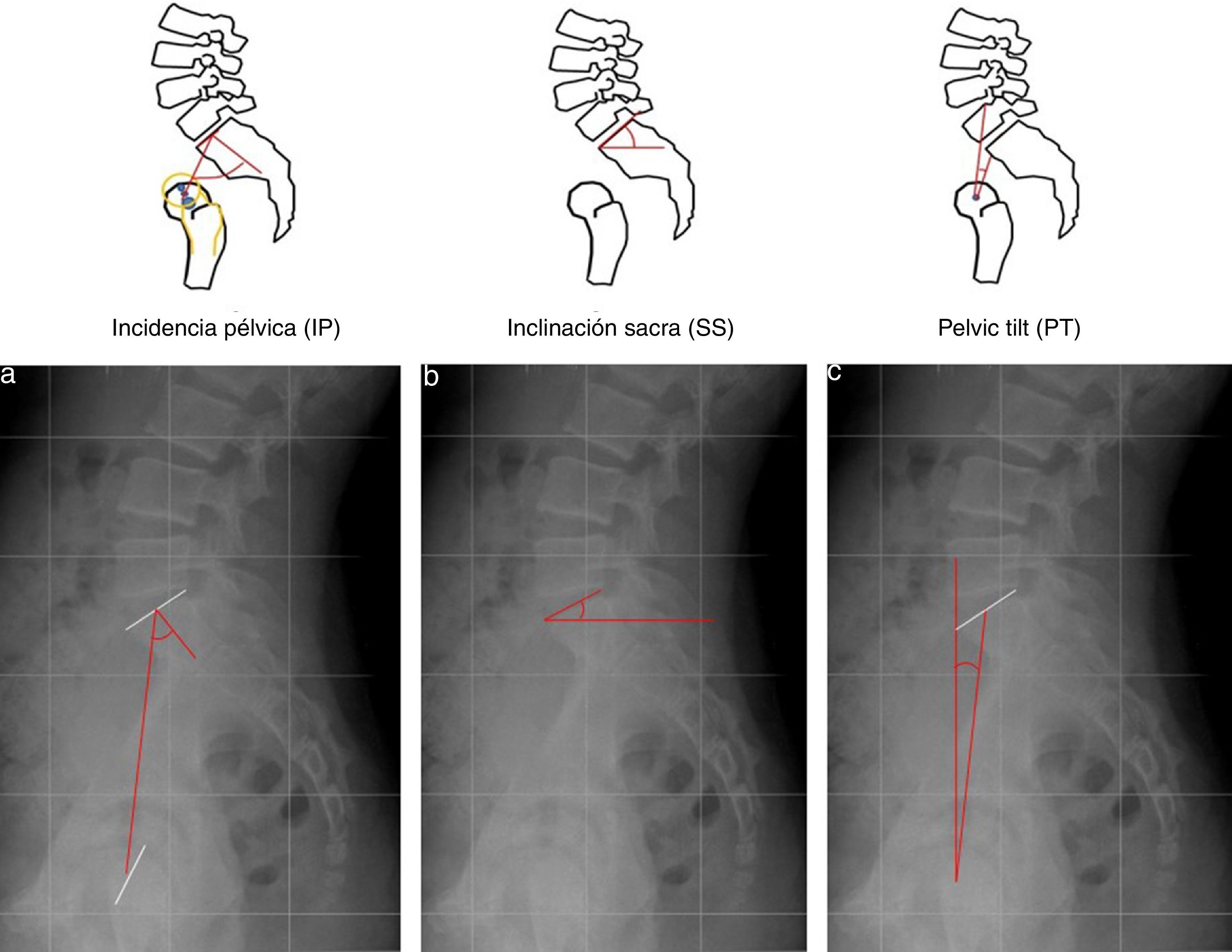 Balance Coronal Radiologia Alteraciones de la alineación vertebral | Radiología