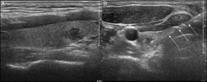 Biopsia de carcinoma papilar de tiroides. A) Nódulo hipoecogénico con bordes mal definidos. B) Mediante Doppler, el nódulo muestra vascularización central. C) Biopsia con aguja gruesa del nódulo descrito (flechas).
