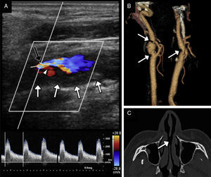 Hombre de 38 años de edad con aterosclerosis acelerada sin factores de riesgo cardiovascular clásicos, consumidor habitual de cocaína. A) Imagen de ecografía Doppler dúplex del segmento cervical de la arteria carótida interna que muestra una placa blanda relativamente homogénea (flechas blancas), de superficie irregular, con ulceración (punta de flecha), que condiciona una estenosis grave de la luz con flujo de alta velocidad turbulento (flecha negra) y velocidad pico sistólica de aproximadamente 300cm/s. B) Reconstrucción volumétrica de TC de ambas arterias carótidas en la que se demuestra la marcada afectación ateroesclerótica bilateral (placas marcadas con flechas). C) Detalle de la imagen transversal del estudio de TC en ventana de hueso en el que se identifica la perforación del tabique nasal (flecha).