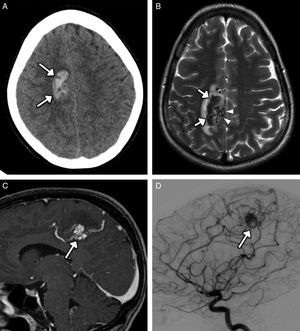 Mujer de 33 años de edad que presenta intensa cefalea y hemiparesia izquierda, en cuyo análisis de tóxicos en orina se detectó cocaína. A) Imagen transversal de TC sin contraste intravenoso en la que se observa un hematoma intraparenquimatoso cortico-subcortical frontal parafalciano derecho (flechas). B) Imagen transversal de RM potenciada en T2 en la que se identifica el hematoma marcadamente hipointenso (flechas), edema vasogénico en su borde lateral y, en su borde medial, un nidus de vacíos de flujo tubulares correspondiente a una malformación arteriovenosa (puntas de flecha). C) Imagen sagital de RM potenciada en T1 con contraste intravenoso que muestra el nidus de la malformación (flecha) con drenaje al seno longitudinal superior. D) Imagen sagital de arteriografía con sustracción digital que confirma la malformación arteriovenosa (flecha).