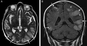 Mujer de 42 años de edad, consumidora esporádica 3,4-metilendioximetanfetamina (MDMA), que acude al hospital por presentar cefalea, alteración visual y crisis hipertensiva por síndrome de encefalopatía posterior reversible. En el examen toxicológico de orina se detectó 3,4-metilendioximetanfetamina (MDMA). A) Imagen transversal de RM potenciada en T2 que muestra un extenso edema cortico-subcortical bilateral confluente de predominio parieto-occipital posterior (flechas). B) Imagen coronal de RM potenciada en T2-FLAIR en la que se identifica el edema (flechas) y su efecto masa con colapso de surcos (puntas de flecha). La clínica y los hallazgos radiológicos se resolvieron a los pocos días con medidas de soporte y control de la presión arterial.