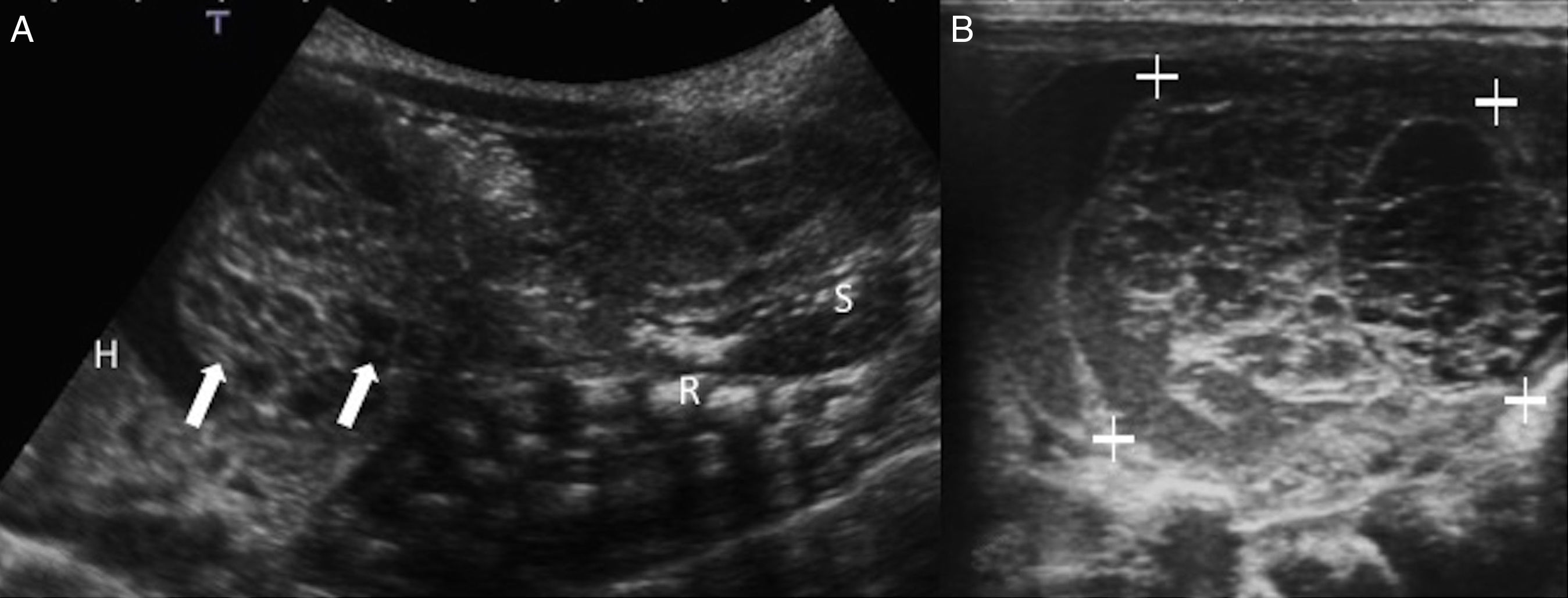 Quistes De Ovario Neonatales Valoraci n Ecogr fica Y Diagn stico quistes-de-ovario-neonatales-valoraci-n-ecogr-fica-y-diagn-stico