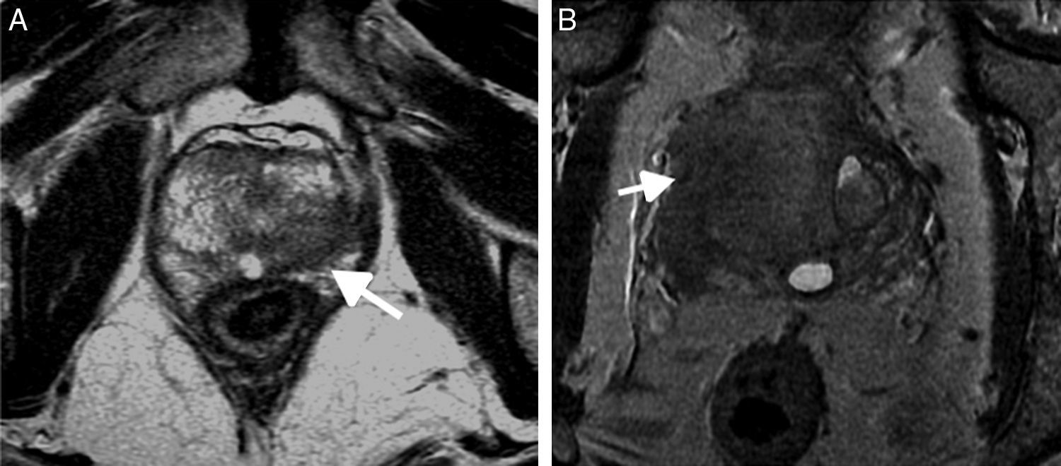 Resonancia magnética de próstata: lectura con el sistema PI-RADS V2 ...