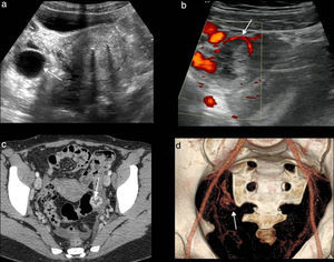 a) Ecografía, corte transversal. Quiste folicular bien delimitado, de pared fina, con contenido anecoico (flecha). b) Ecografía Doppler color, corte transversal, de un cuerpo lúteo. Imagen quística con pared más gruesa, ecogénica y vascularizada (flecha). c) Tomografía computarizada (TC) con contraste, corte axial. Imagen típica de un cuerpo lúteo con pared engrosada, hiperdensa, con bordes festoneados (flecha). d) TC, VR: se identifica el anillo vascularizado del cuerpo lúteo (flecha).