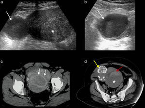 Miomas. a y b) Ecografías, cortes transversales. Mioma intramural (asterisco) y mioma subseroso con un área anecoica en su interior que representa un foco de degeneración hialina (flechas). c) Tomografía computarizada (TC) con contraste, corte axial. Mioma intramural con degeneración hialina que se muestra como una masa hipodensa que no realza con el contraste (flechas). d) TC sin contrate, corte axial. Mioma intramural (asterisco) con imagen semilunar hiperdensa debido a contenido hemorrágico. Mioma subseroso calcificado (flecha amarilla).