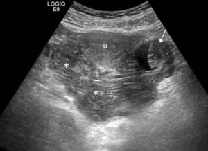 Rotura de embarazo ectópico. Ecografía, corte axial. Líquido libre con tabiques y ecos en su interior que se localiza posterior al útero, compatible con hemoperitoneo (asteriscos), e imagen de masa anexial izquierda (flecha) de aspecto complejo, con área quística y polo sólido en su interior.
