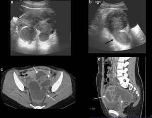 Enfermedad inflamatoria pélvica avanzada. a) Ecografía, corte transversal. Absceso tubo-ovárico (entre marcas) que se presenta como una masa loculada, de apariencia compleja, afectando a la trompa uterina y al ovario. b) Ecografía, corte longitudinal. Piosálpinx con trompa uterina dilatada con contenido líquido complejo en su interior (flecha). c y d) Tomografía computarizada con contraste, cortes axial y sagital. Masa loculada, con múltiples estructuras quísticas serpiginosas de paredes engrosadas, compatibles con abscesos (flechas blancas). Se aprecia realce del peritoneo adyacente (flecha negra).