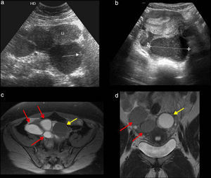 Endometriomas. a y b) Ecografías, cortes transversales. a) Múltiples quistes con contenido ecogénico de bajo nivel, uno de ellos con foco ecogénico debido a calcio en su pared (flecha). b) Imagen típica de endometrioma (línea punteada entre marcas) con ecos internos de bajo nivel. c) Resonancia magnética (RM), T1, con saturación grasa, corte axial. Estructuras quísticas hiperintensas que corresponden a endometriomas (flechas rojas), y quiste funcional de baja intensidad de señal (flecha amarilla). d) RM, T2, corte coronal. Endometriomas con baja señal de intensidad, efecto shadding (flechas rojas), y quiste funcional hiperintenso (flecha amarilla).