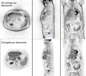 Ejemplo de imagen de PET sin corregir (arriba) y corregida (abajo) por el efecto de la atenuación de la radiación dentro del paciente.