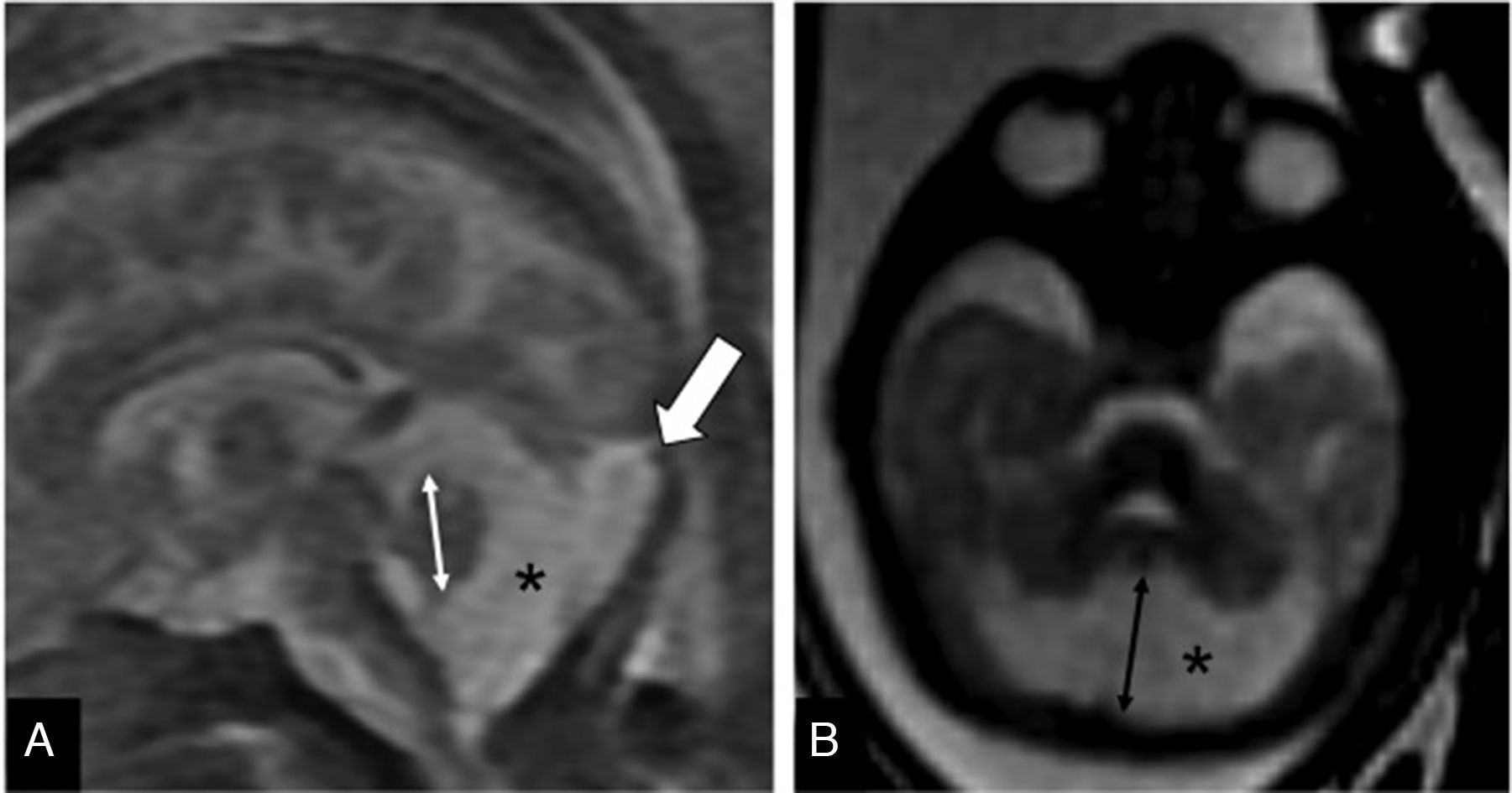 High Torcula Valoración del cerebelo fetal mediante resonancia magnética | Radiología