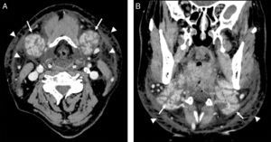Imagen axial (A) y coronal (B) de tomografía computarizada cervical con contraste intravenoso en la que se observa marcado aumento de ambas glándulas submaxilares (flechas), que se muestran hipercaptantes y con engrosamiento de los septos glandulares. Se asocia a moderados cambios inflamatorios en la grasa circundante y en el tejido celular subcutáneo (puntas de flecha). No se visualizan colecciones definidas en la región cervical.