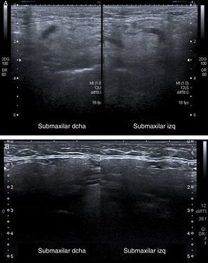 A) Imagen de ecografía cervical con sonda lineal en la que se observa un aumento difuso del tamaño de ambas glándulas submaxilares, que presentan un aspecto edematoso con pérdida de la diferenciación del contorno glandular. B) Ecografía cervical realizada a las 48 horas en la que se observa una adecuada diferenciación del parénquima glandular con desaparición de los signos inflamatorios.
