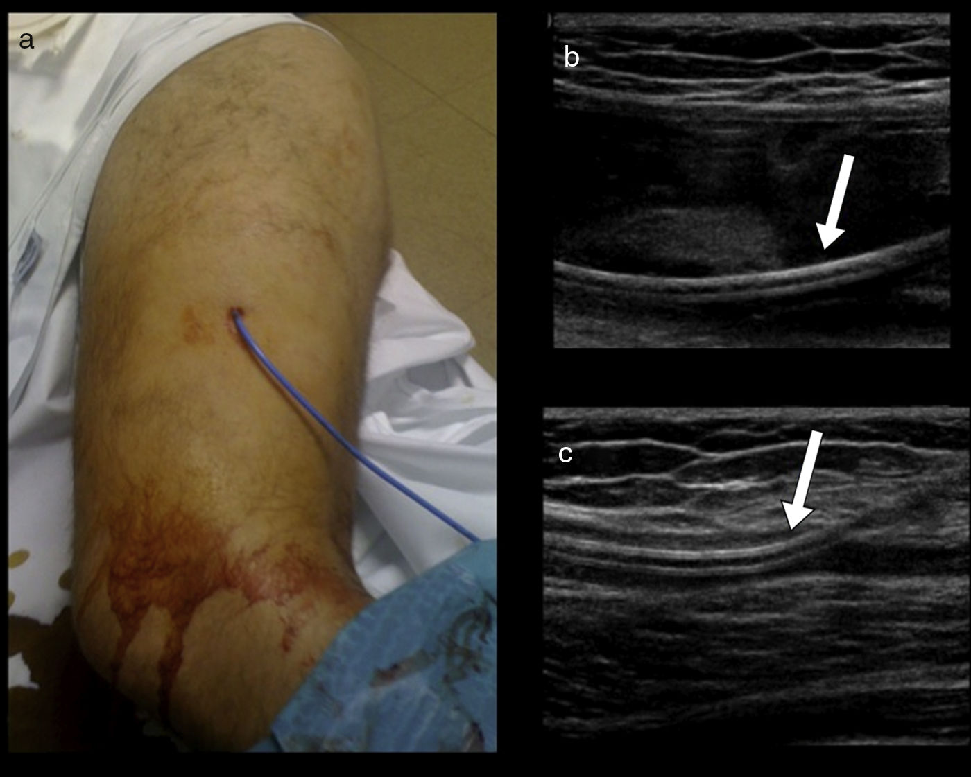 Lesión de MorelLavallée diagnóstico y tratamiento con técnicas de