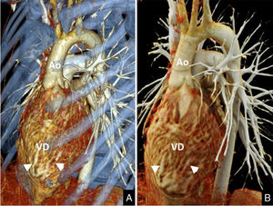 Angio-TC torácica en un varón de 18 años diagnosticado de cardiopatía congénita del tipo de la transposición congénitamente corregida de las grandes arterias por inversión ventricular. A) Reconstrucción volumétrica. B) Reconstrucción cinemática. Nótese la discordancia ventrículo-arterial que presenta el paciente: del ventrículo morfológicamente derecho (VD), que presenta hipertrofia de la banda moderada (puntas de flecha), se origina la aorta (Ao).