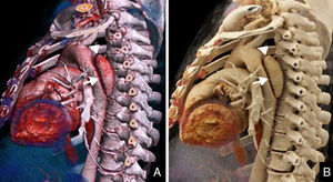 Angio-TC aórtica en un varón de 42 años que acudió a urgencias por dolor interescapular tras esfuerzo físico resistente a analgesia; el paciente se encontraba hipertenso a su llegada (PA 200/100mmHg). Se realizó una angio-TC para descartar disección de aorta. A) Reconstrucción volumétrica. B) Reconstrucción cinemática. El estudio puso de manifiesto una disección de aorta DeBakey de tipo III (flechas) que se originaba distal a la arteria subclavia izquierda (puntas de flecha) y se extendía a lo largo de la aorta toracoabdominal hasta la arteria ilíaca derecha.