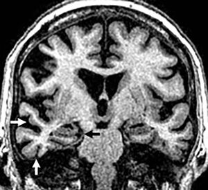Deterioro cognitivo en varón de 72 años con clínica de demencia frontotemporal variante semántica. Secuencia coronal T1 3D en la que se observa atrofia temporal basal y lateral asimétrica de predominio derecho (flechas blancas) con hipocampos normales (flecha negra).