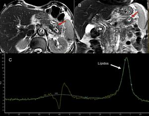 Varón de 74 años que ingresa por dolor abdominal. Las imágenes turbo espín eco potenciadas en T2 en plano axial (A) y coronal (B) usadas como referencia para la localización de la lesión muestran una masa de aproximadamente 4 cm, de aspecto quístico, localizada en el cuerpo-cola del páncreas, marcadamente hiperintensa en T2 (flechas rojas). La espectroscopia con tiempo de eco (TE) corto 35 ms (C) evidencia un pico de lípidos a 1,3 ppm, lo que probablemente indica la presencia de necrosis. La cirugía confirmó una lesión cavitada con contenido necrohemorrágico y revestimiento epitelial compatible con tumor mucinoso.
