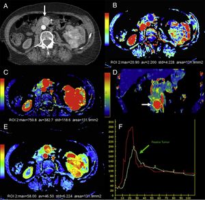 Tomografía computarizada (TC) con perfusión en un paciente con cáncer de células claras en el riñón izquierdo (asterisco) y una metástasis en el uncinado pancreático (flechas). TC con contraste en fase arterial (A), mapas paramétricos en el plano axial de permeabilidad (B), de flujo sanguíneo en planos axial (C) y coronal (D), de volumen sanguíneo (E) y curvas de captación de la aorta y del tumor (F). En los mapas de color se demuestran altos valores de flujo y volumen sanguíneo y bajos de permeabilidad en la lesión metastásica pancreática en comparación con el páncreas normal. La curva realce-tiempo muestra el realce de la metástasis pancreática (curva verde) de morfología similar a la de la aorta (curva roja).