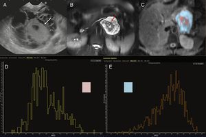 Mujer de 45 años con una tumoración quística en la cola del páncreas. Imagen de ultrasonografía endoscópica (USE) (A), imagen de resonancia magnética (RM) potenciada en T2 con saturación grasa (B), mapa de ADC con segmentación en color de las porciones periférica (azul) y central (rosa) (C) e histogramas correspondientes a los valores de ADC de dichas partes de la masa (D y E). La imagen endoscópica y la de RM potenciada en T2 con saturación de la grasa demuestran una masa quística con un componente central sólido (flechas blanca en la imagen de USE y roja en la de RM potenciada en T2). El análisis del mapa de ADC permite distinguir la porción quística periférica (segmentada en azul) con unos valores altos de ADC en el histograma (E) y un valor medio del mismo de 2,7, mientras que la porción central sólida (segmentada en color rosa) en el mapa de ADC presenta valores menores (D), con un ADC medio de 2,1. Tras la cirugía, el diagnóstico anatomopatológico fue de cistadenocarcinoma mucinoso.