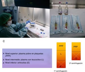 A) Una vez realizada la segunda centrifugación, se procede a la obtención del plasma rico en plaquetas (PRP) en condiciones de esterilidad. B) Después, se introduce en jeringas para su posterior administración y queda preparado para su inyección en bolsas estériles. C) Esquema de obtención del PRP a partir del plasma pobre en plaquetas (PPP), tras dos centrifugaciones.