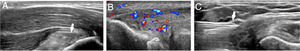 A) Imagen ecográfica de epicondilitis con engrosamiento del tendón común extensor y alteración de su patrón fibrilar (flecha). B) Epicondilitis con neovascularidad tendinosa. C) Inyección con guía ecográfica de plasma rico en plaquetas con aguja 21 G (flecha) del tendón común extensor.