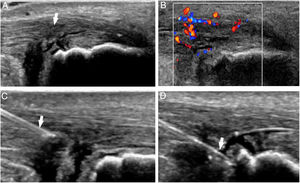 Ecografía de tendinopatía del tendón de Aquiles (flecha en A) con neovascularidad (B). Ante la sintomatología persistente con tratamiento conservador, se infiltró plasma rico en plaquetas intratendinoso en el área de mayor heterogeneidad fibrilar (flechas en C y D).