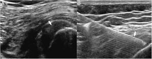 A) Tendinopatía del bíceps femoral/semitendinoso (flecha) resistente a todas las terapias conservadoras empleadas. B) Se administraron tres tandas de plasma rico en plaquetas intratendinoso con aguja espinal (flecha) con escasa mejoría del dolor en escala visual analógica, aunque mayor que con otros tratamientos.